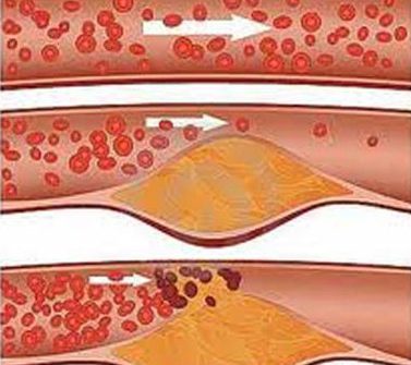 bệnh mỡ máu, điều trị mỡ máu, giảm mỡ máu, mỡ máu và cách điều trị, thuốc chữa bệnh mỡ máu cao, mỡ máu cao, chữa mỡ máu cao, điều trị mỡ máu cao, mỡ máu cao nên ăn gì, mỡ trong máu cao, phòng bệnh mỡ máu, phòng bệnh mỡ máu cao, phòng bệnh máu nhiễm mỡ