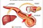 ldl cholesterol