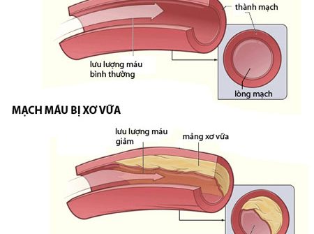 Bệnh mỡ trong máu cao nguy hiểm như thế nào?