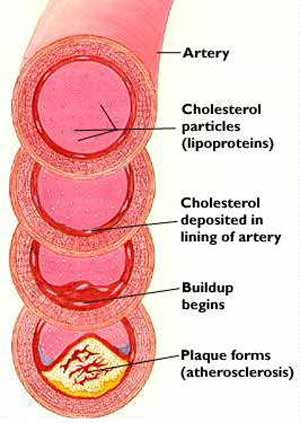 cholesterol máu