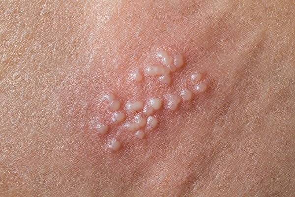 Mụn rộp và các bệnh lây qua đường tình dục khiến vùng kín sưng ngứa